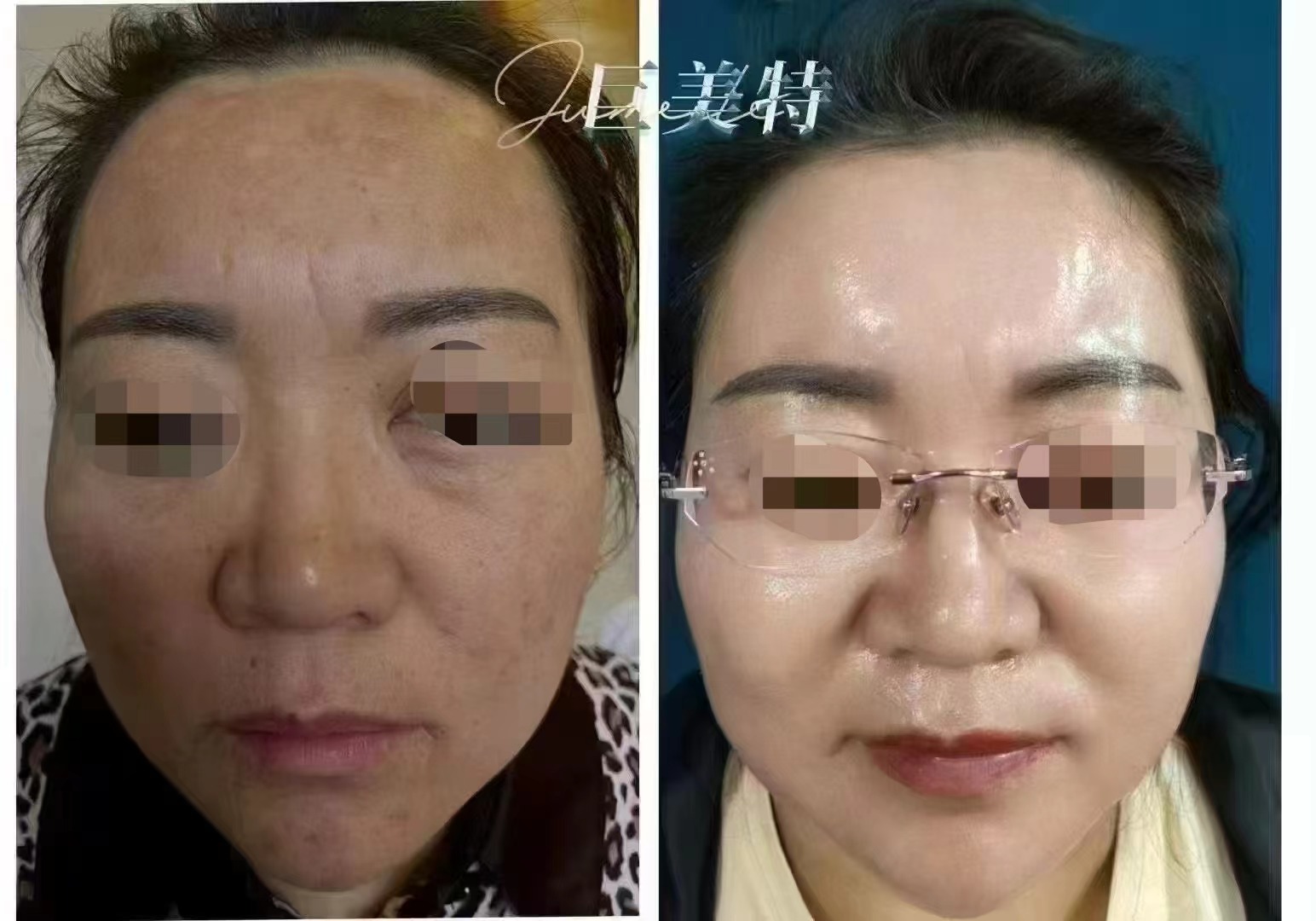 汉焱巨美特祛斑案例